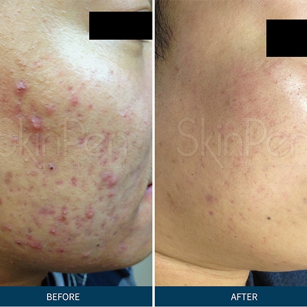 Microneedling Before & after Treatment result in Brooklyn NY by Skin Envy Cosmetic and Laser Center