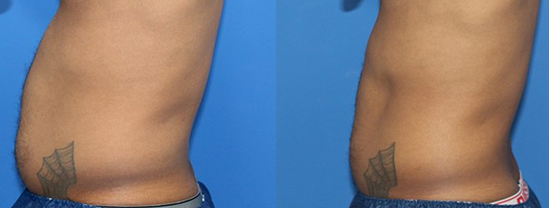 Trusculpt-flex Before & after Treatment in Brooklyn NY by Skin Envy Cosmetic and Laser Center