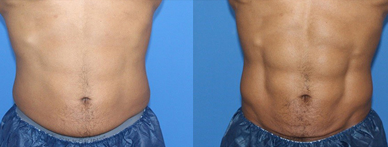 Trusculpt-flex Before & after Treatment in Brooklyn NY by Skin Envy Cosmetic and Laser Center