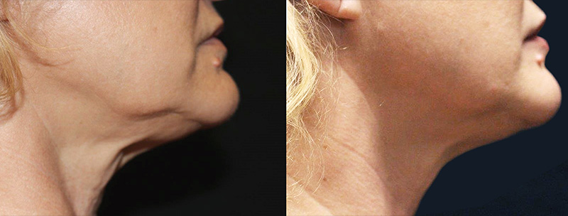 Trusculpt-id-neck Before & after Treatment in Brooklyn NY by Skin Envy Cosmetic and Laser Center