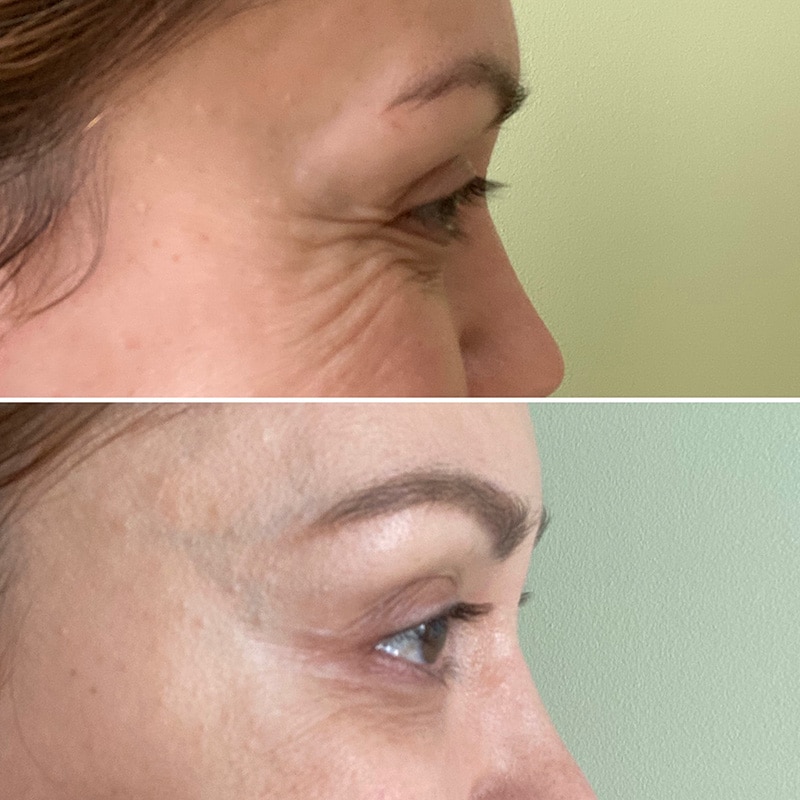 Wrinkle-relaxers Before & after Treatment result in Brooklyn NY by Skin Envy Cosmetic and Laser Center
