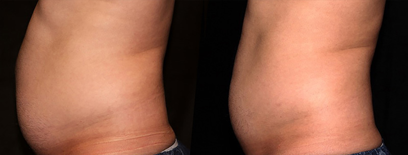Trusculpt ID Before & after Treatment in Brooklyn NY by Skin Envy Cosmetic and Laser Center