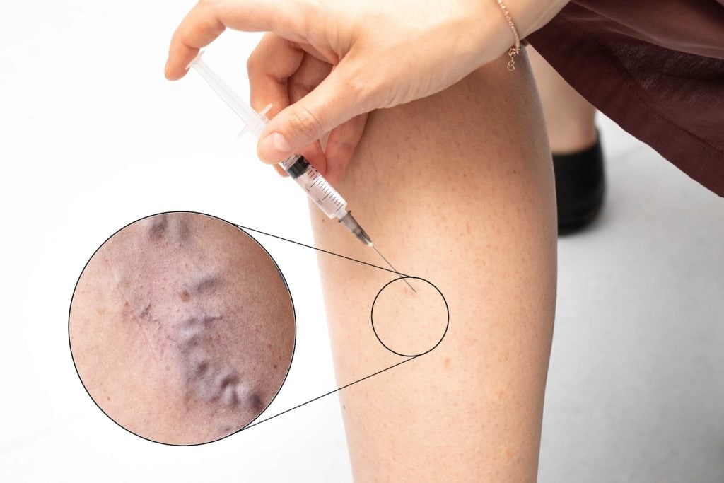 Is Sclerotherapy A Safe Method To Treat Bulging Forehead Veins