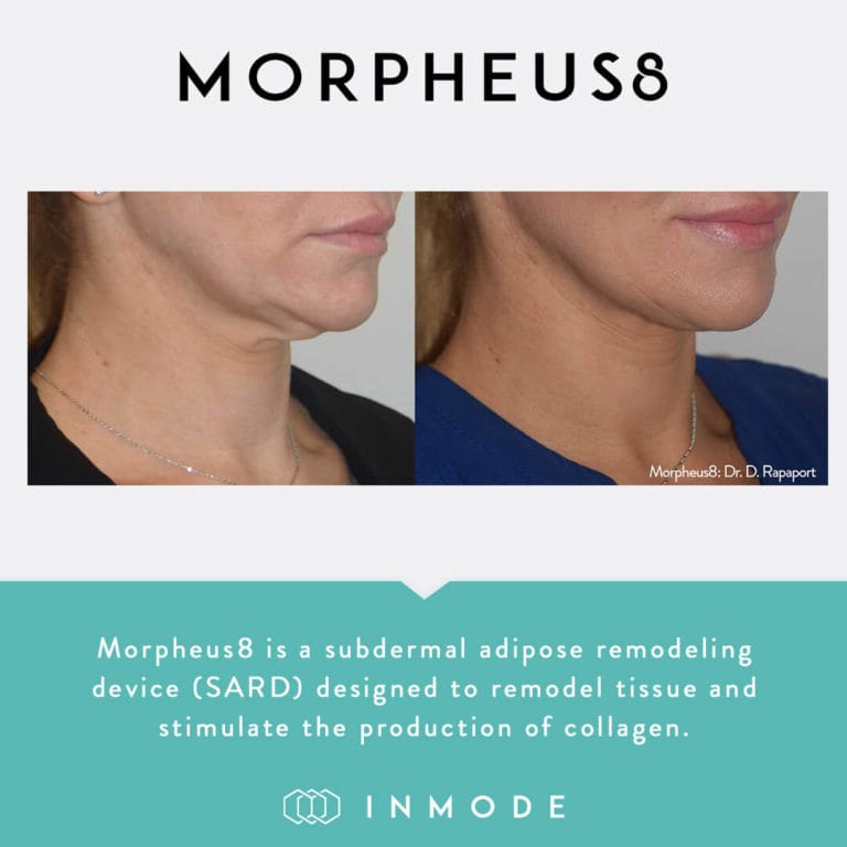 Morpheus8 Before and after skinenvyny 3
