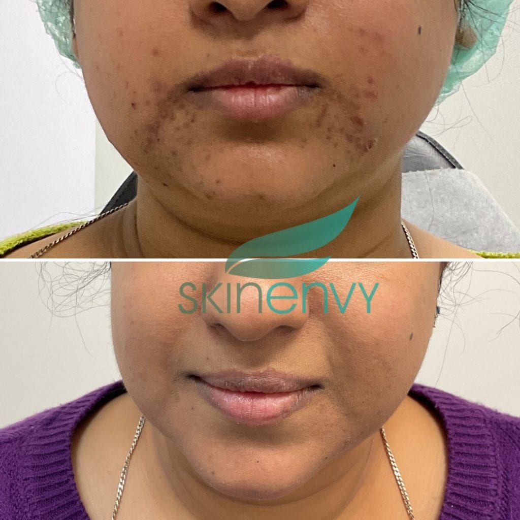 Laser Genesis Treatment In Brooklyn, NY Skin Envy