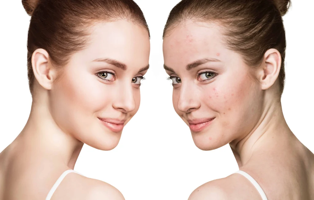 How Can Laser Genesis Transform Your Skin? 10 Laser Genesis By Skin Envy INC DBA Skin Envy Cosmetic and Laser Center in Brooklyn NY