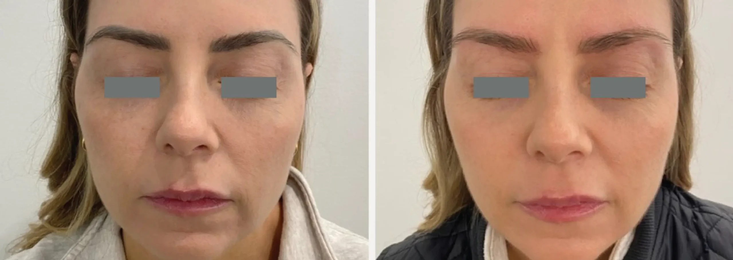 Face and Neck 1 1 scaled