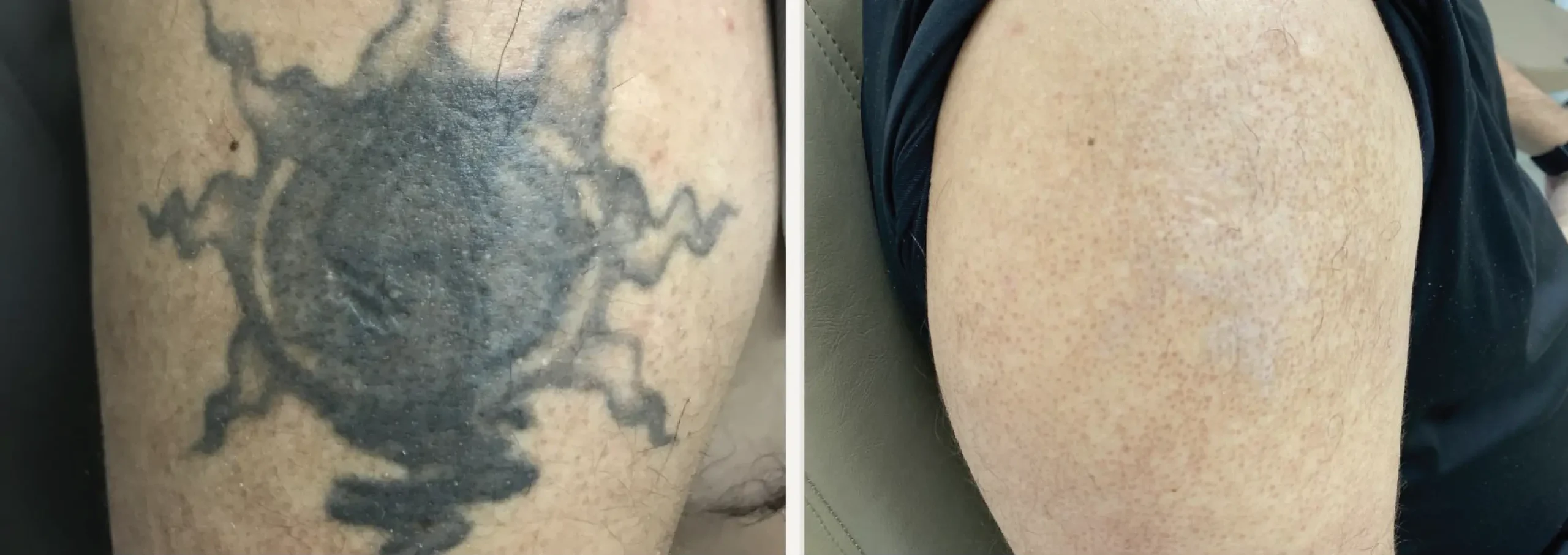 Laser Tattoo Removal 1 scaled