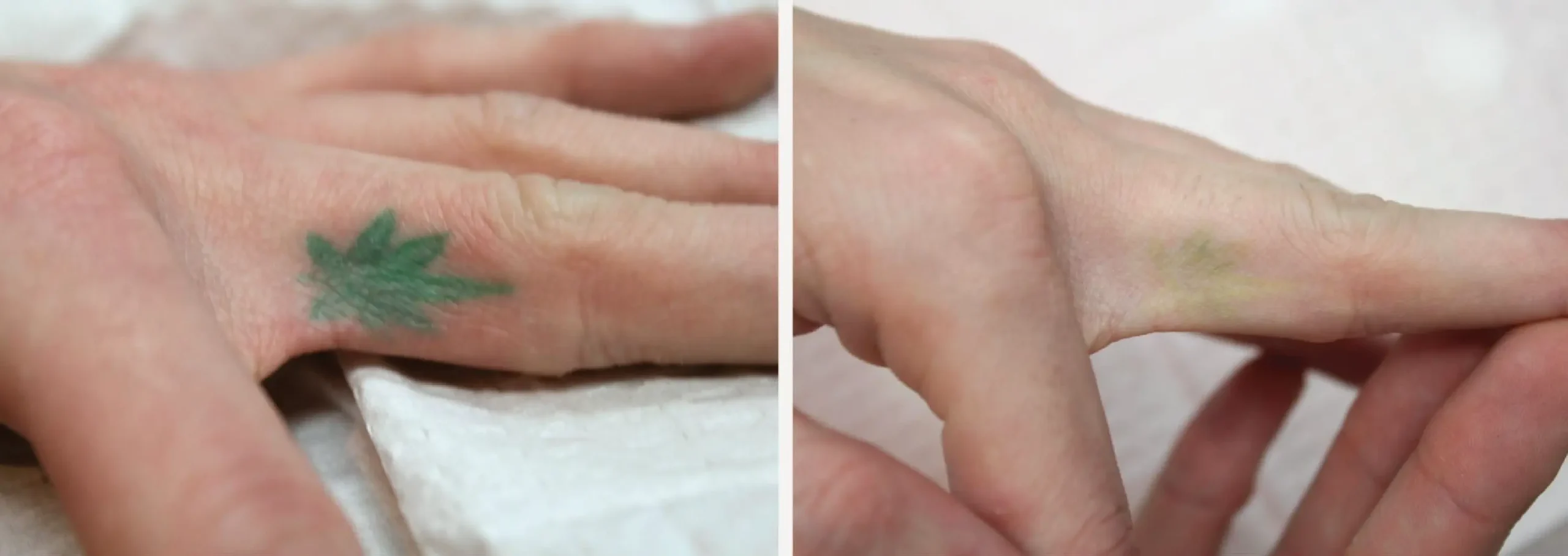 Laser Tattoo Removal 10 scaled