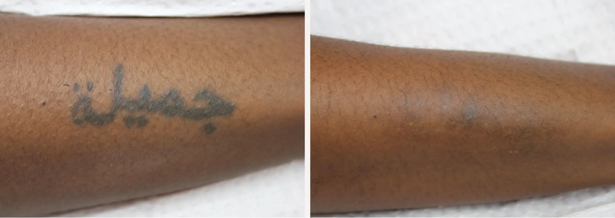 Laser Tattoo Removal 11 scaled