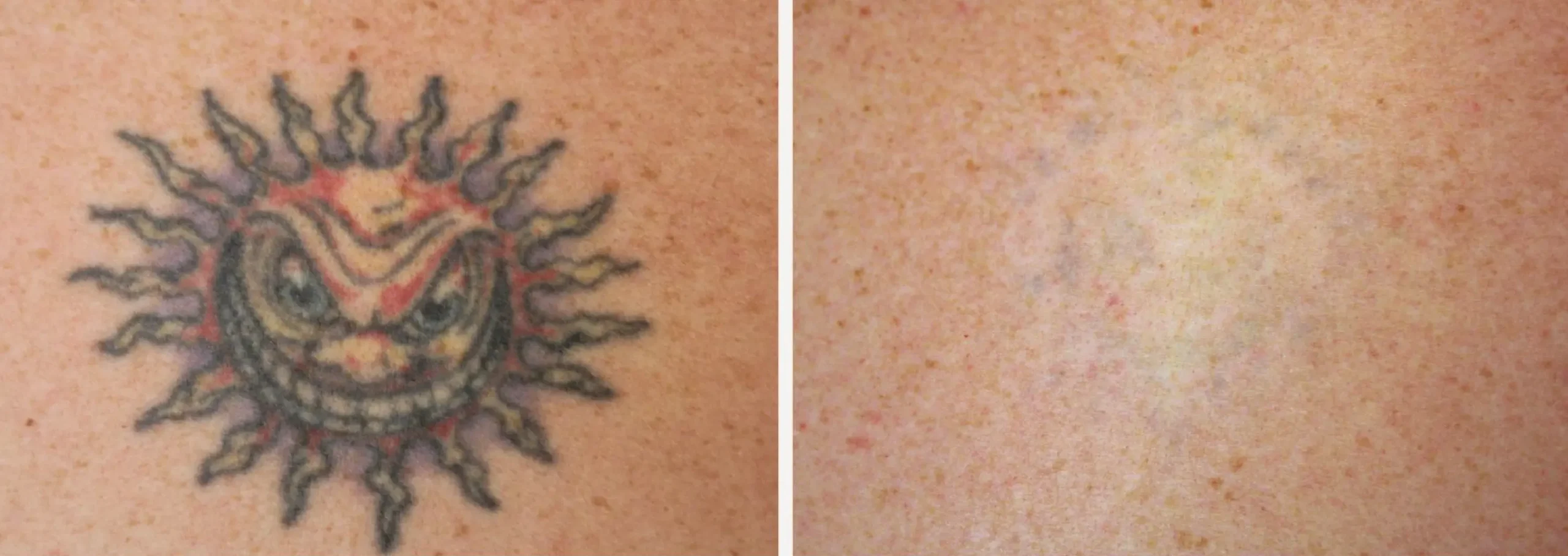 Laser Tattoo Removal 12 scaled
