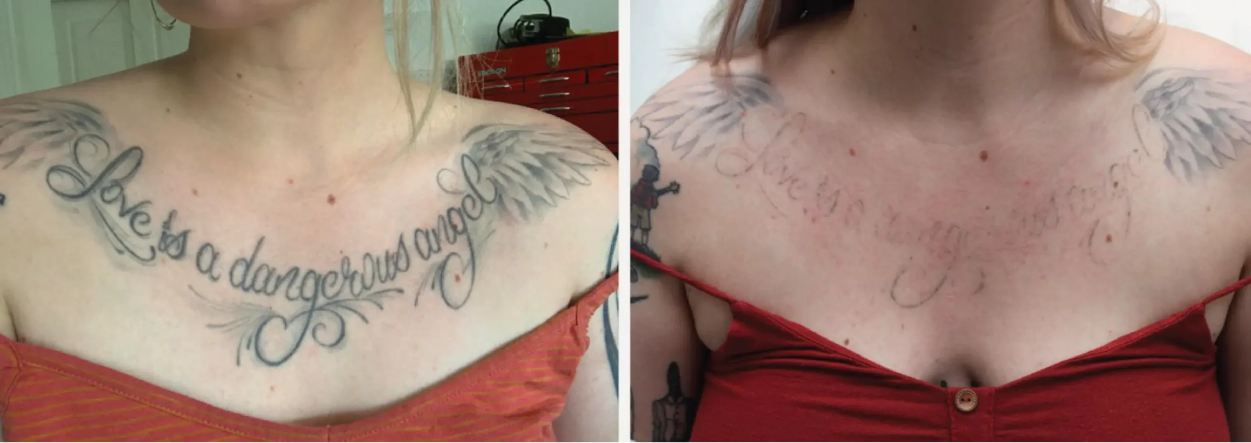 Laser Tattoo Removal 13 scaled