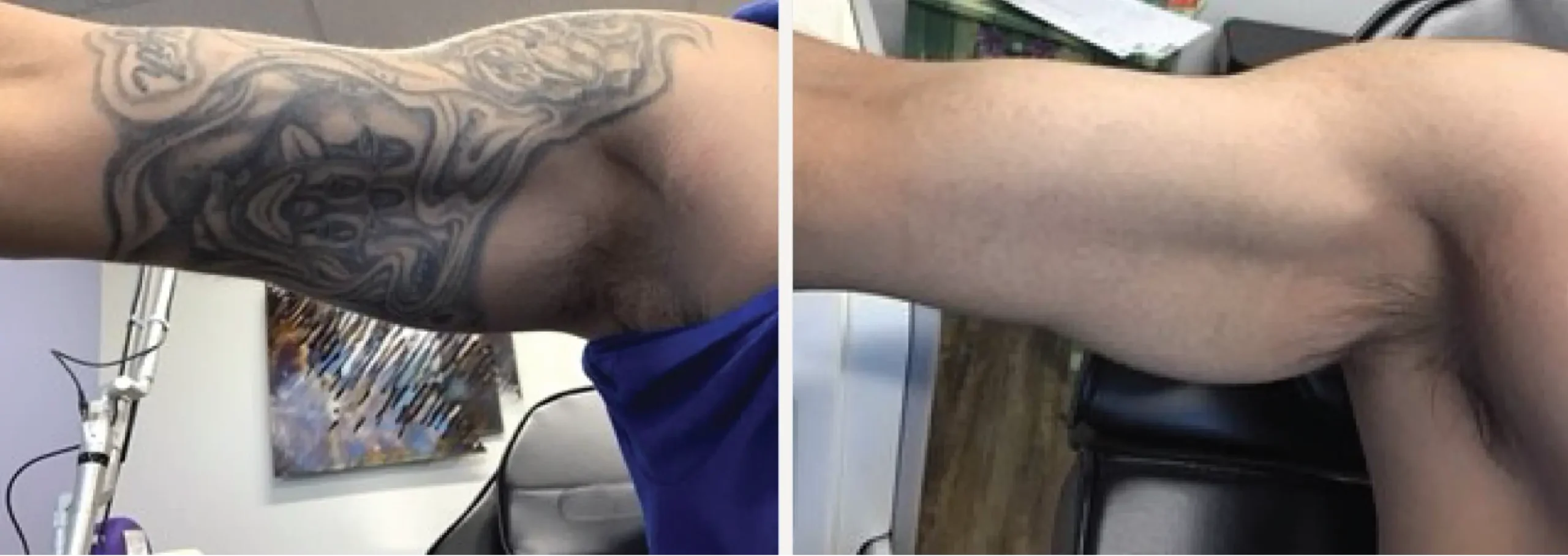 Laser Tattoo Removal 14 scaled