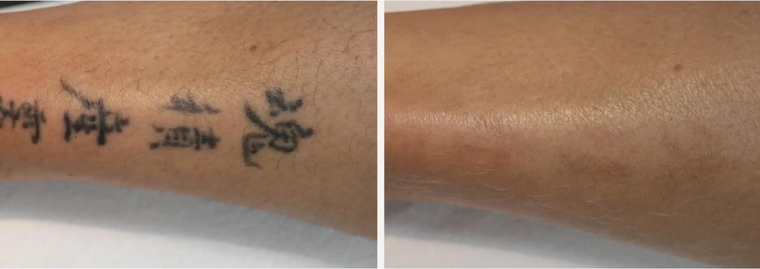 Laser Tattoo Removal 15 scaled