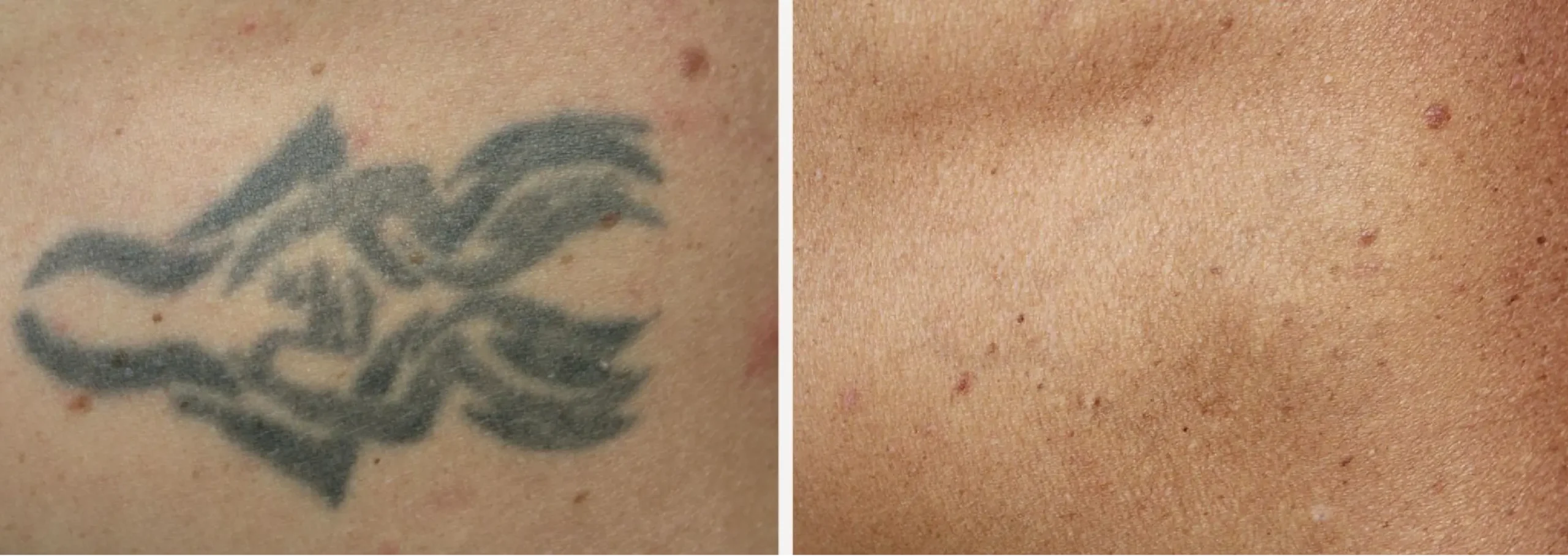 Laser Tattoo Removal 16 scaled