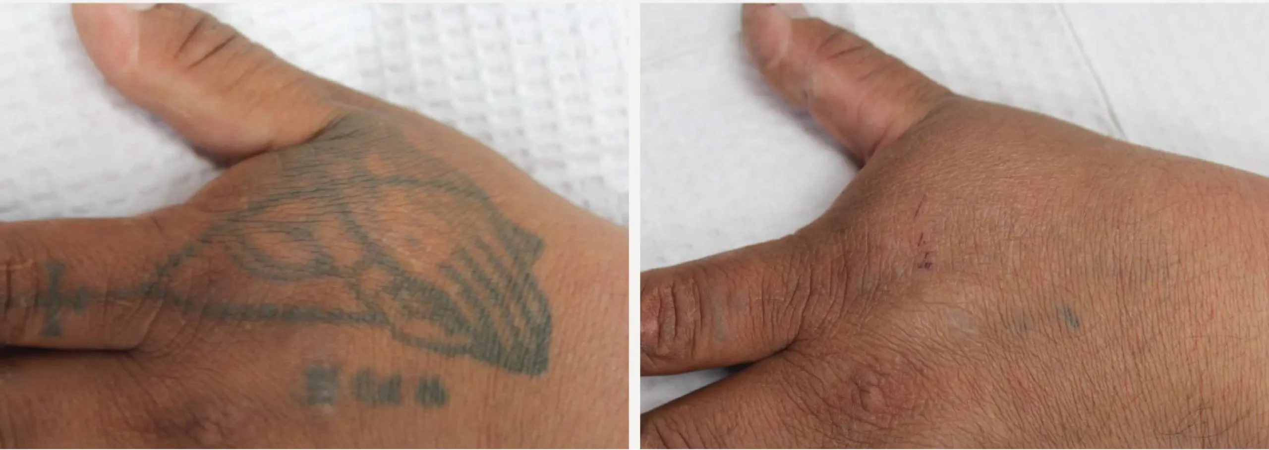 Laser Tattoo Removal 17 scaled