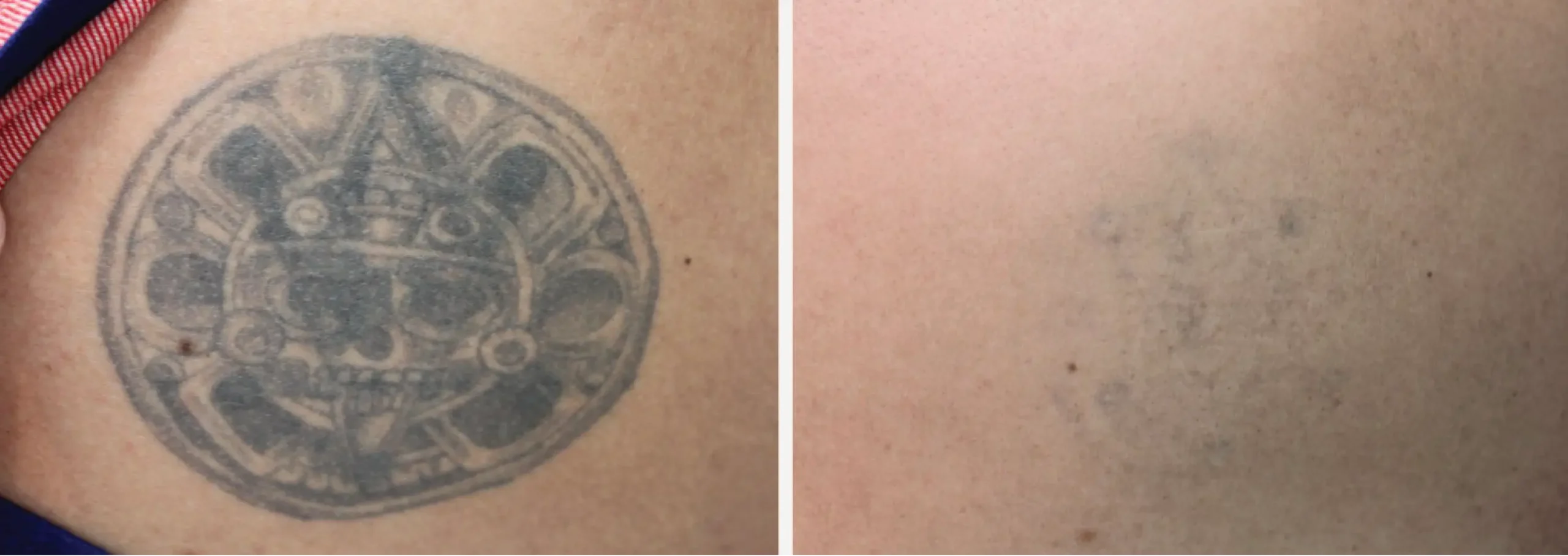 Laser Tattoo Removal 18 scaled