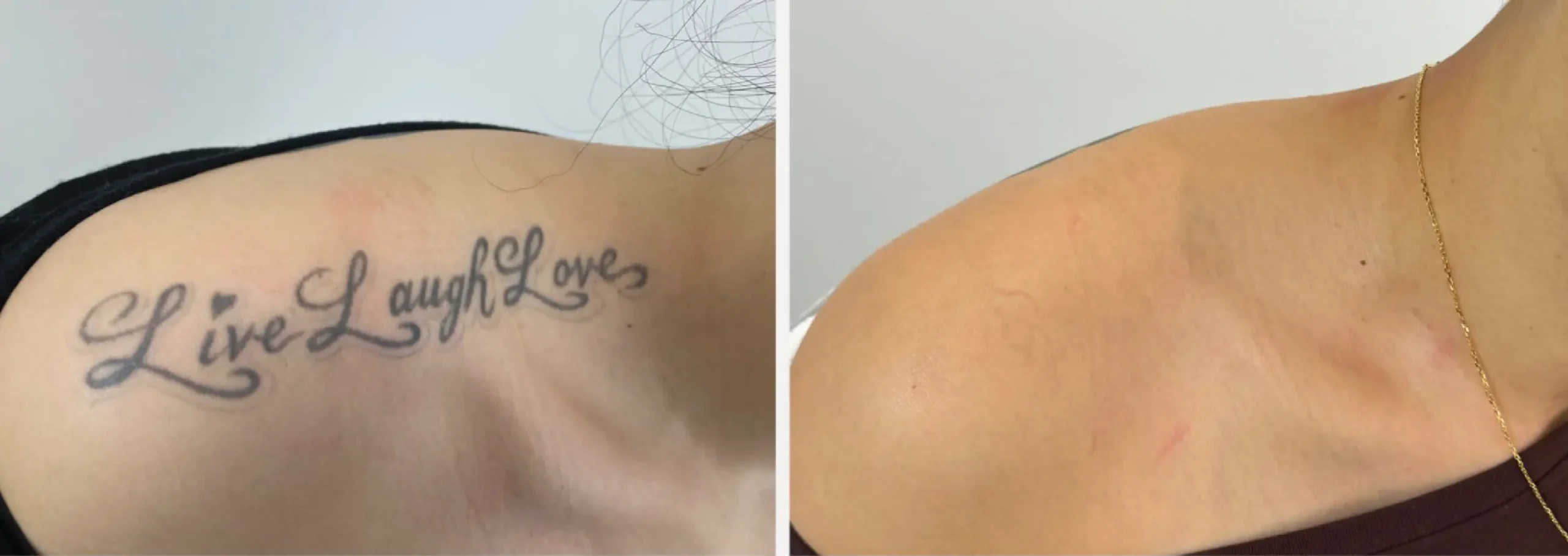 Laser Tattoo Removal 19 scaled