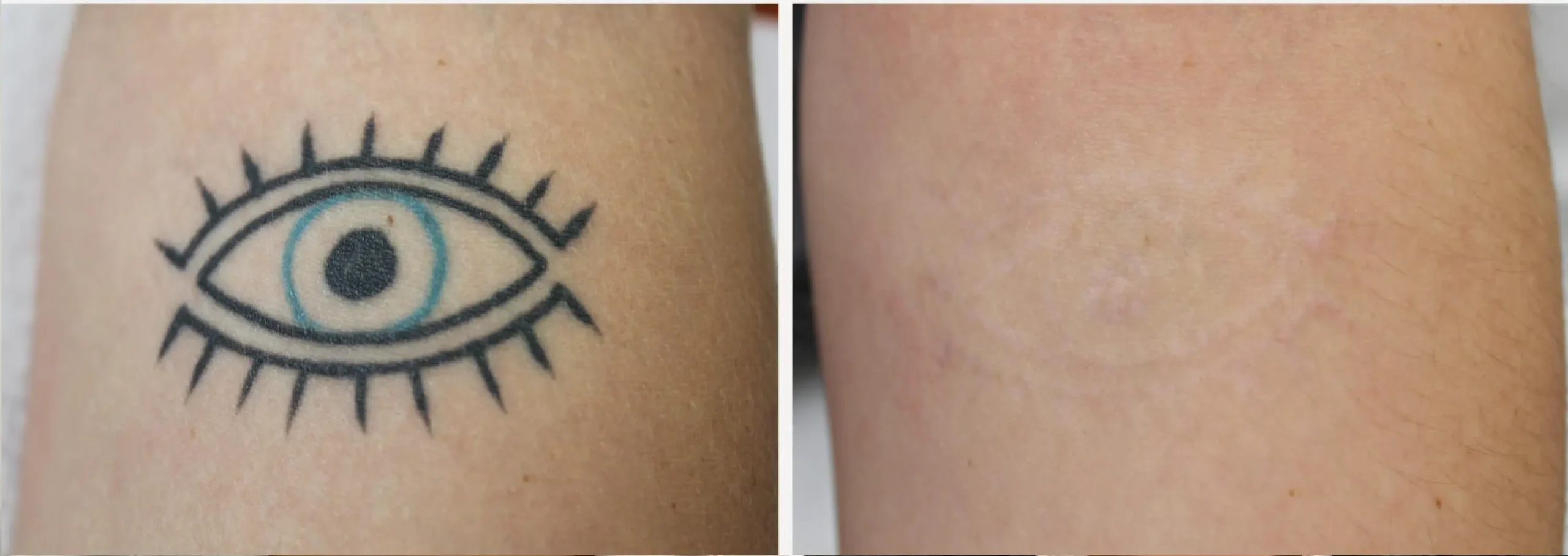 Laser Tattoo Removal 2 scaled