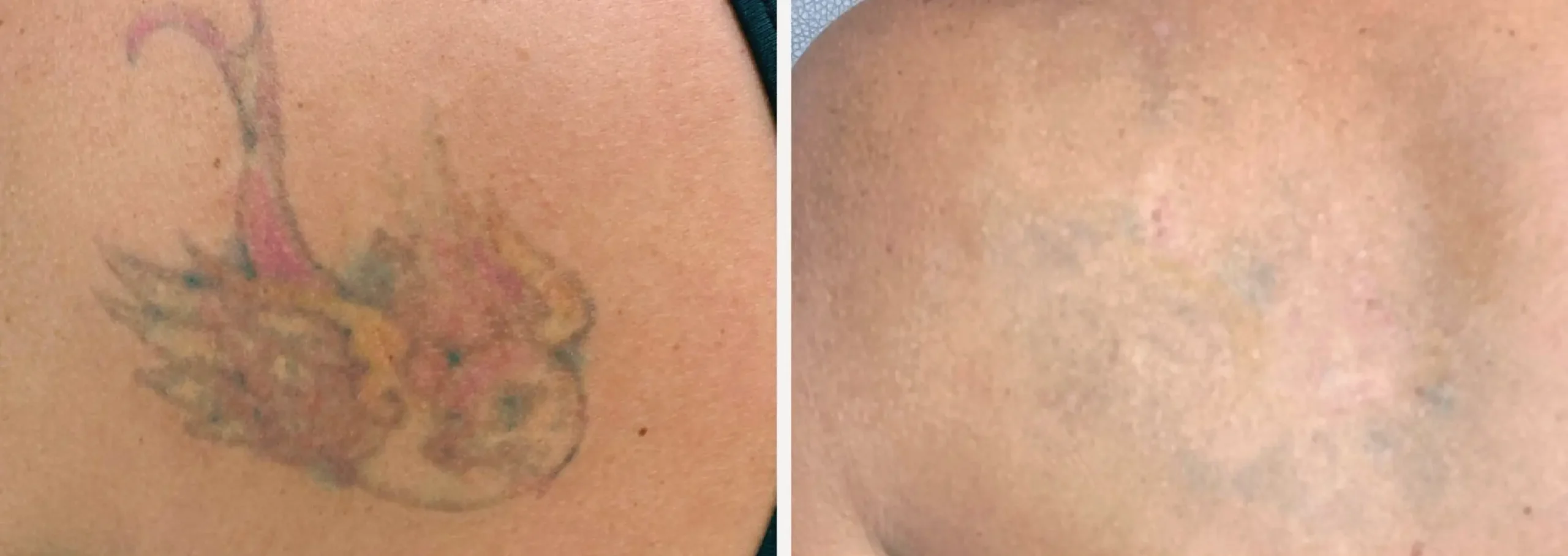Laser Tattoo Removal 21 scaled