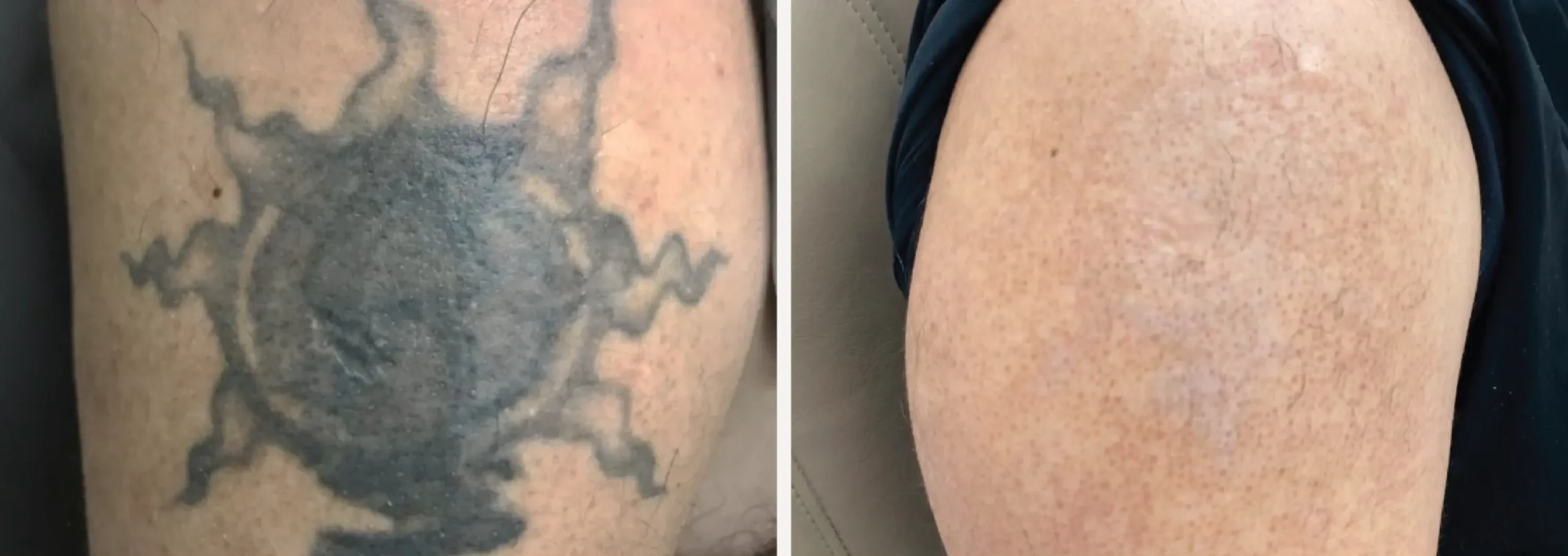 Laser Tattoo Removal 22 scaled