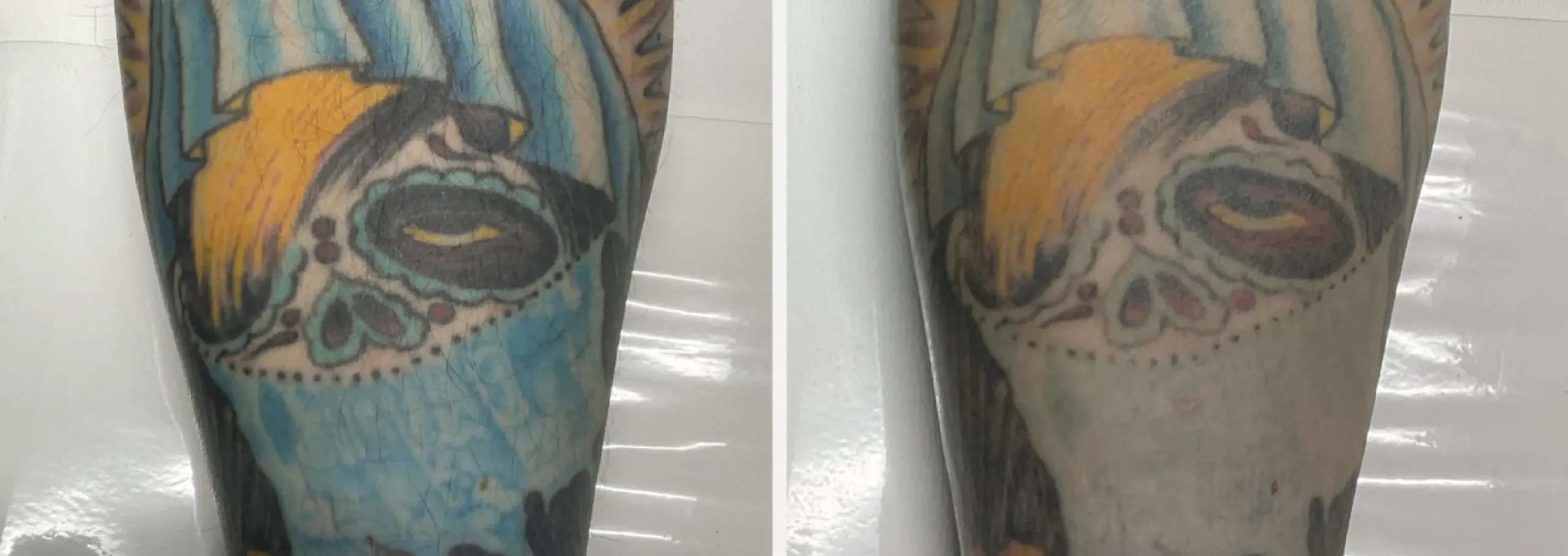 Laser Tattoo Removal 23 scaled