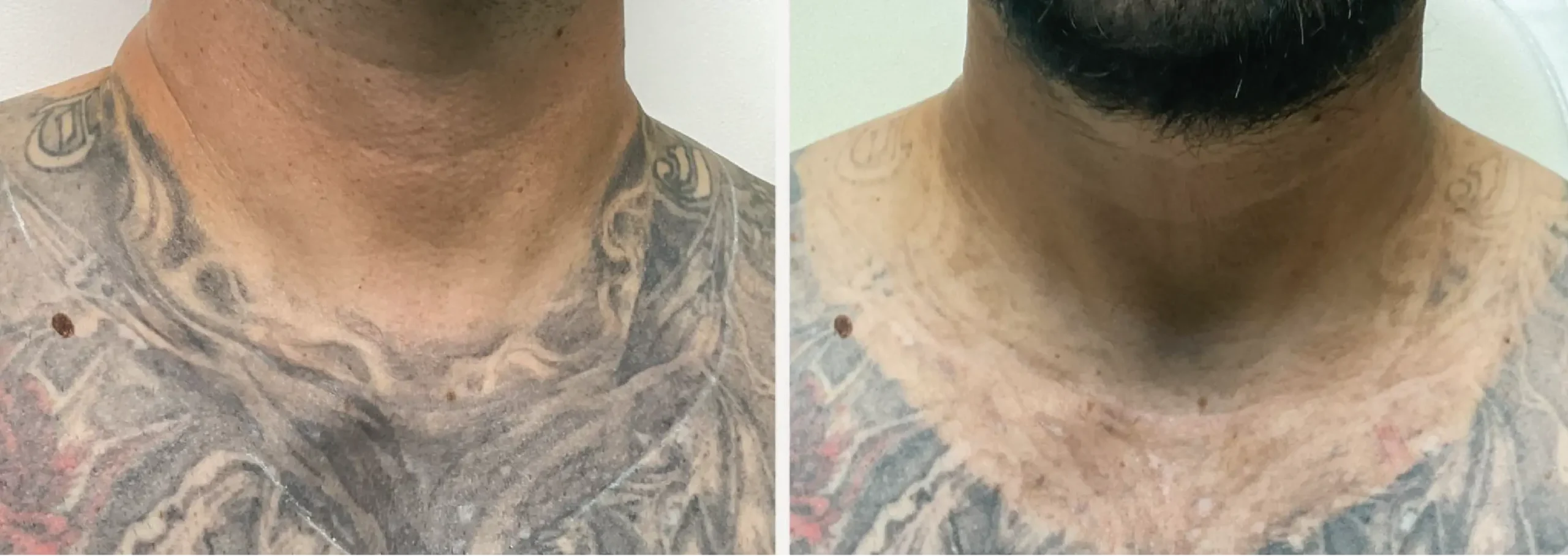 Laser Tattoo Removal 24 scaled