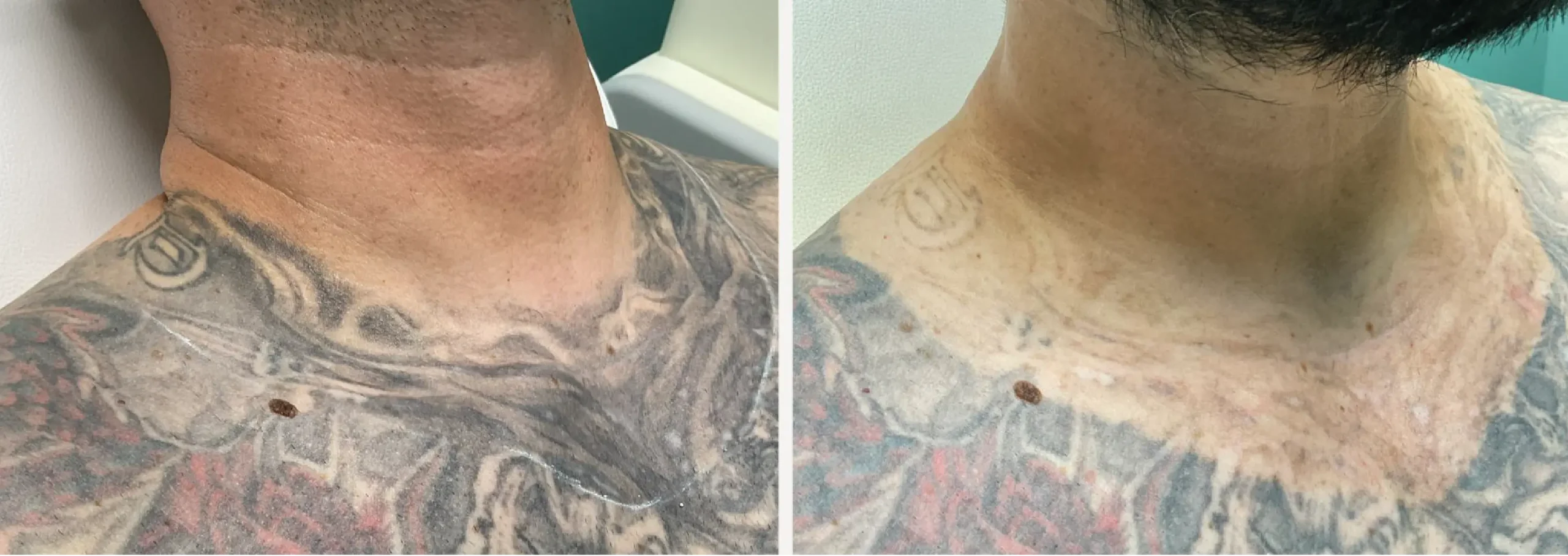 Laser Tattoo Removal 25 scaled
