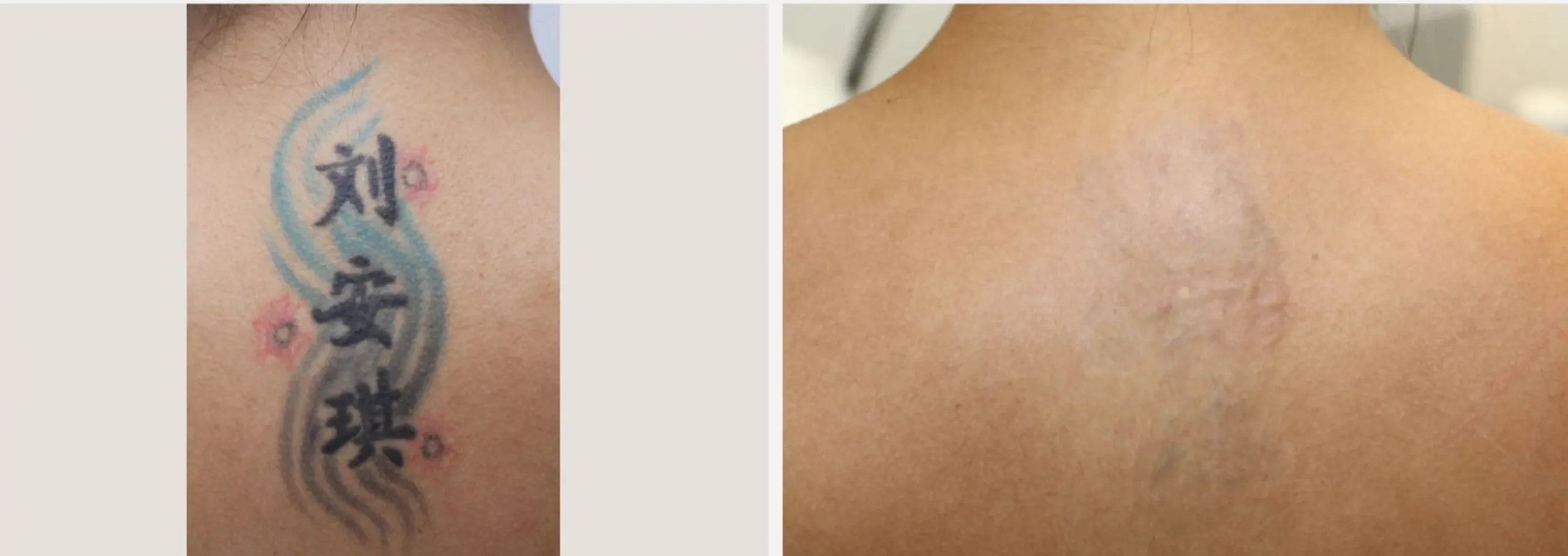 Laser Tattoo Removal 3 scaled