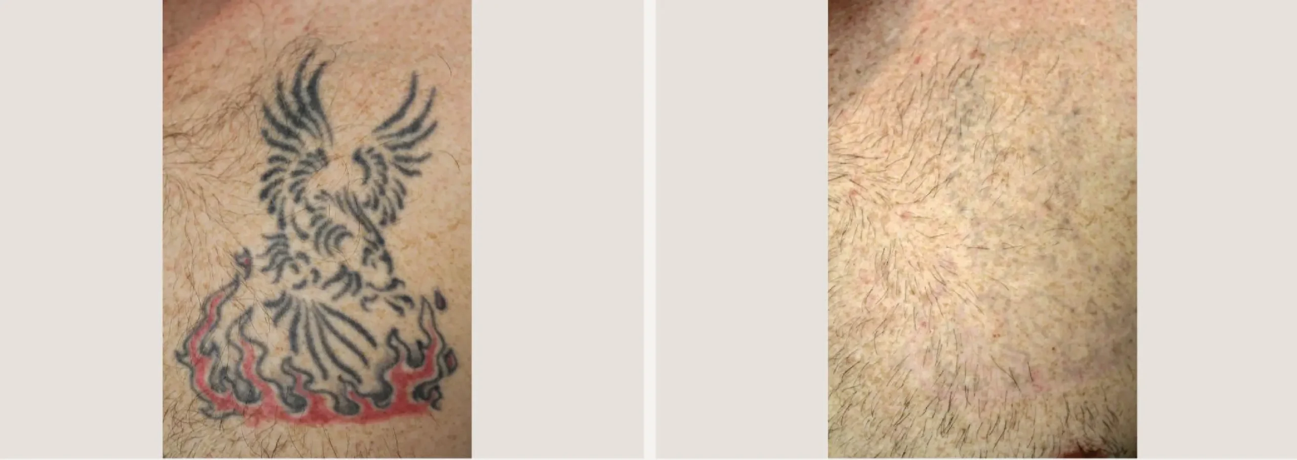 Laser Tattoo Removal 4 scaled