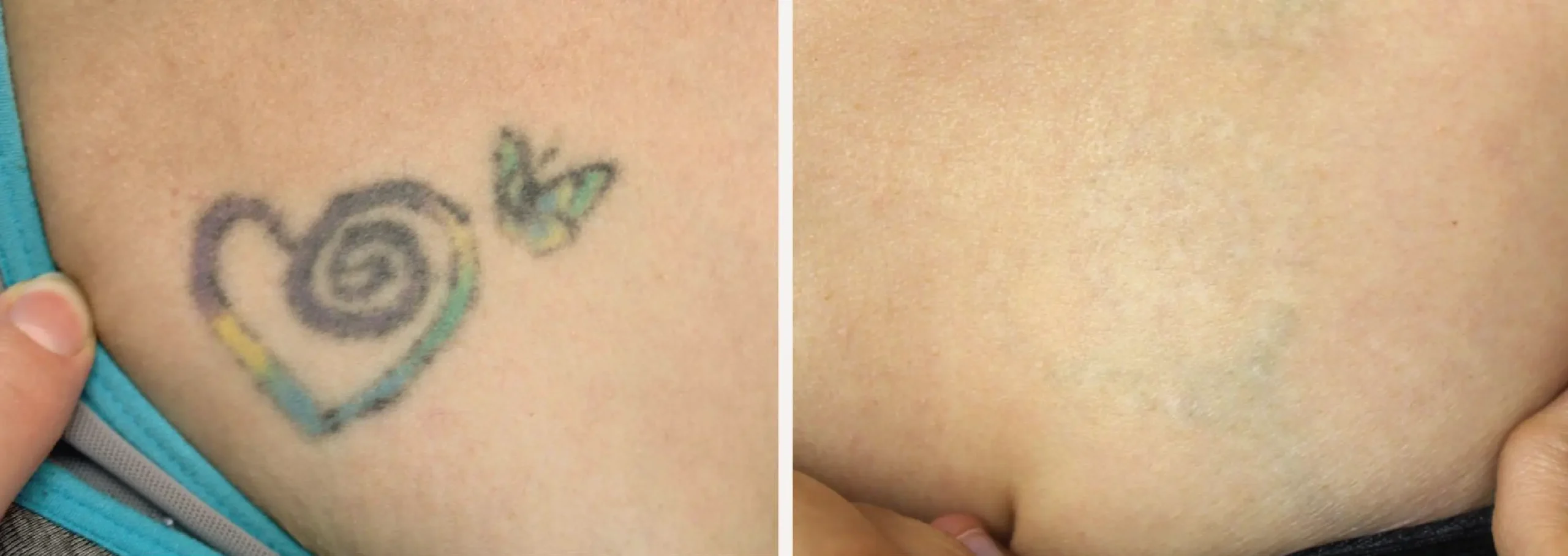 Laser Tattoo Removal 6 scaled