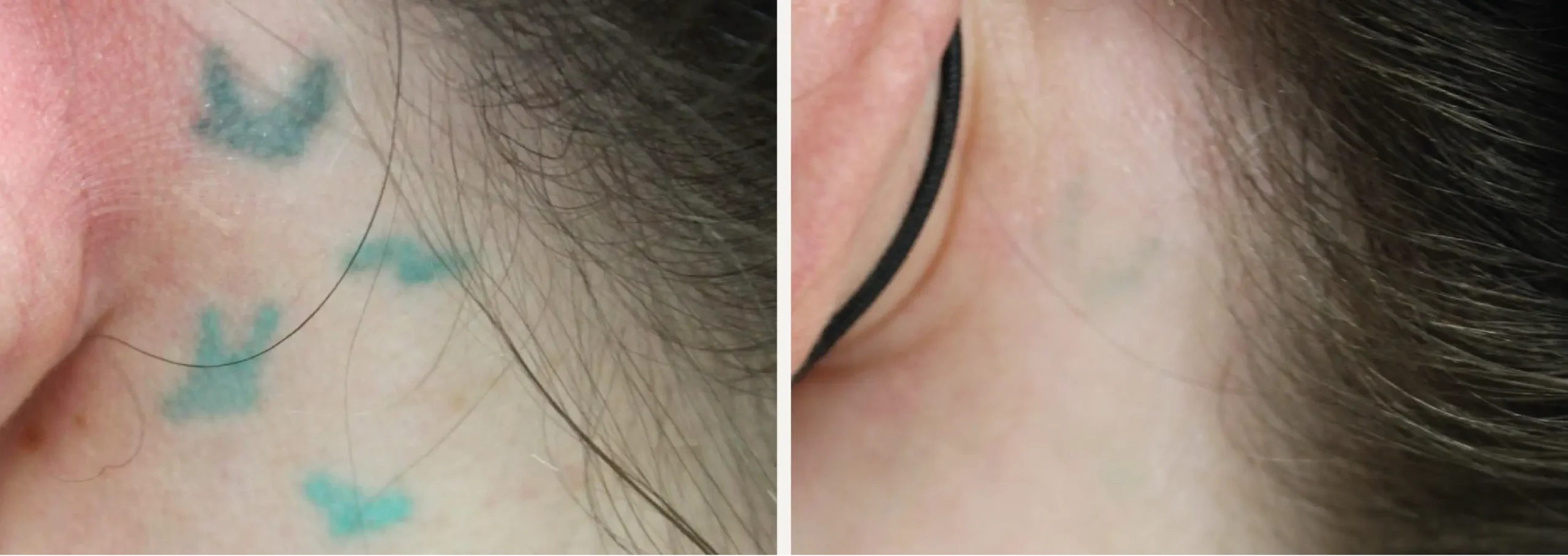 Laser Tattoo Removal 7 scaled