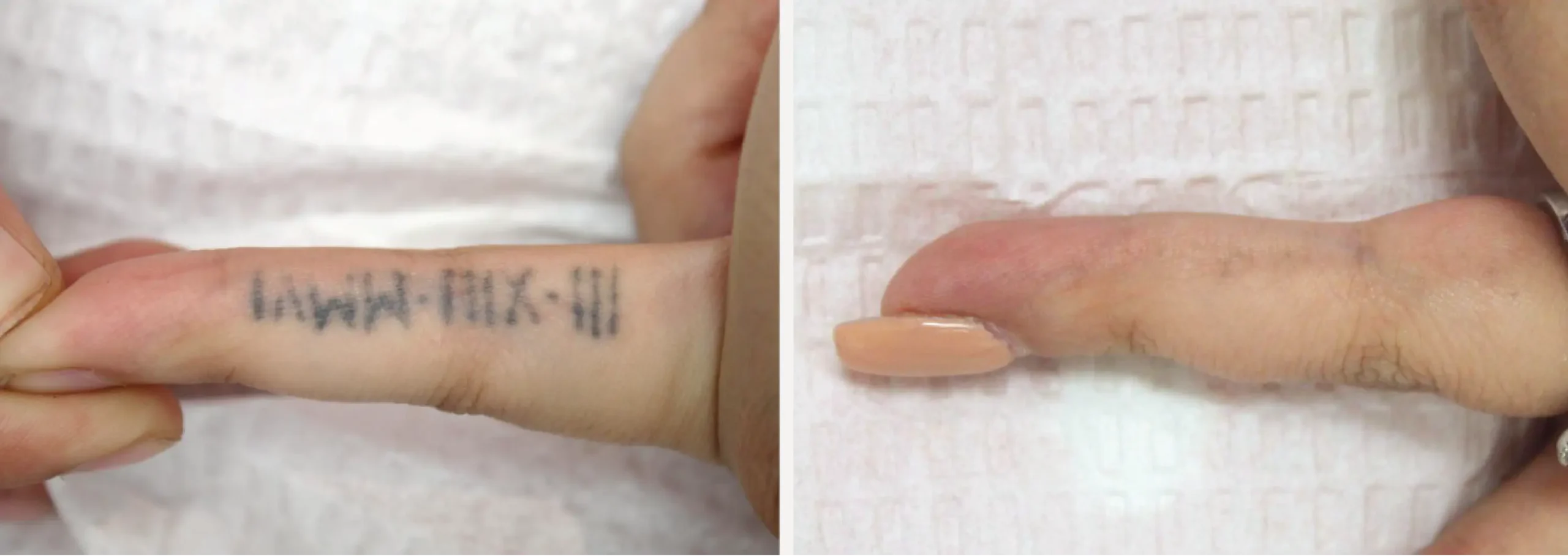 Laser Tattoo Removal 8 scaled