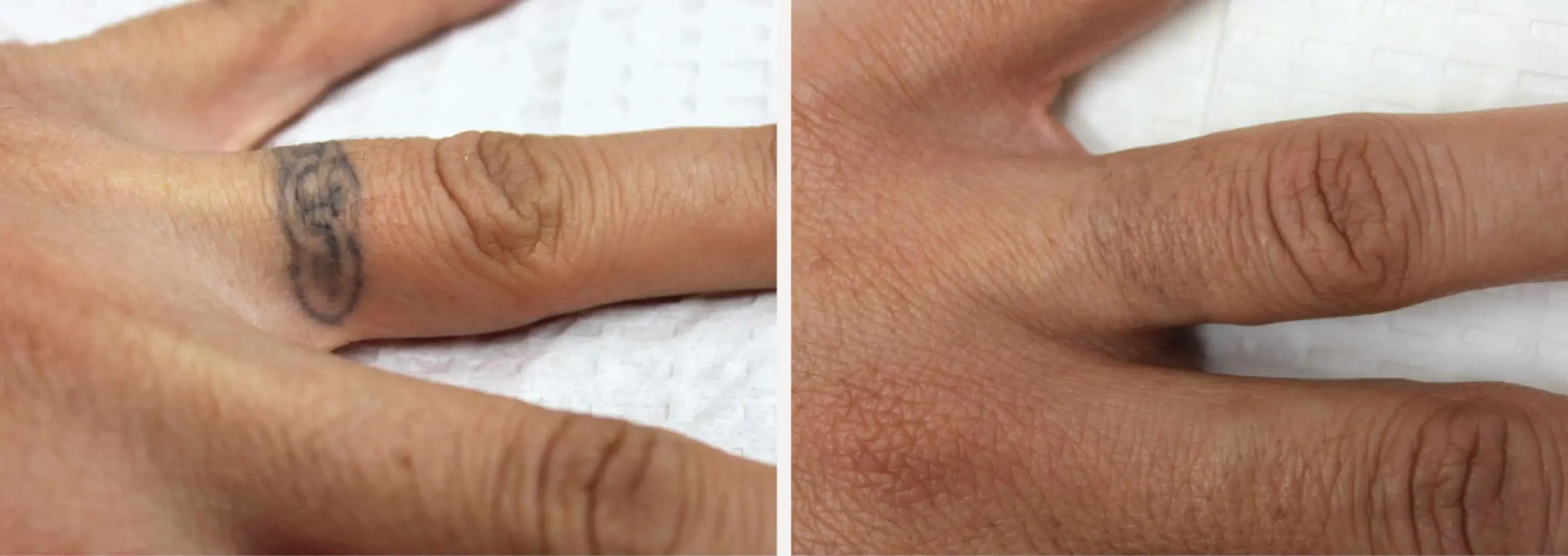 Laser Tattoo Removal 9 scaled