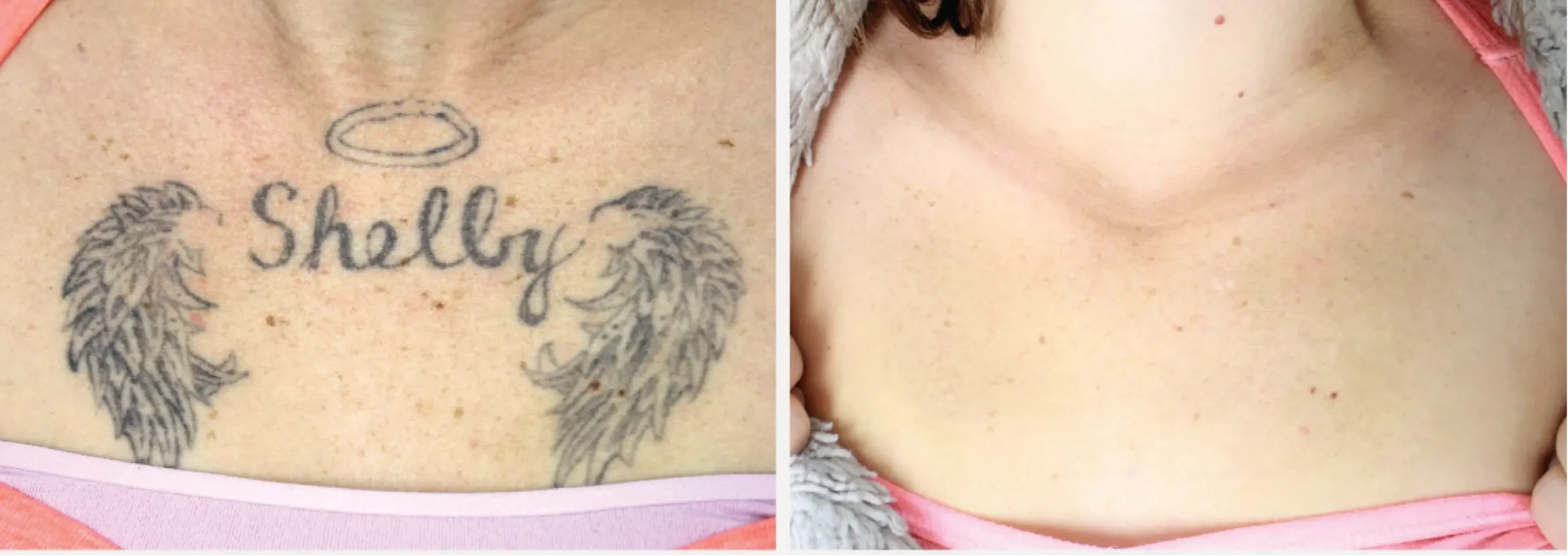Laser Tattoo Removal5 scaled