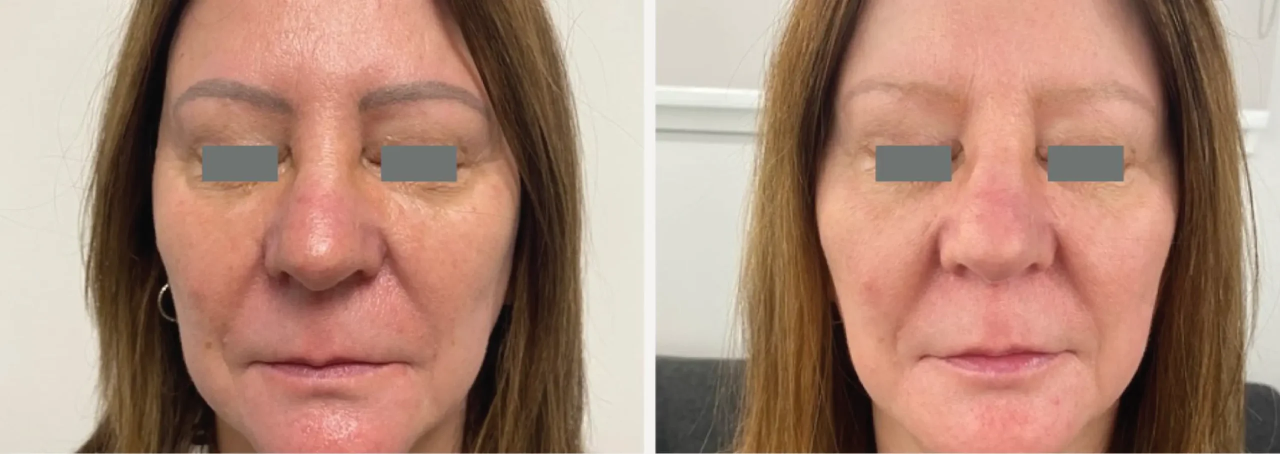 PicoWay® Pigment Removal 2 scaled