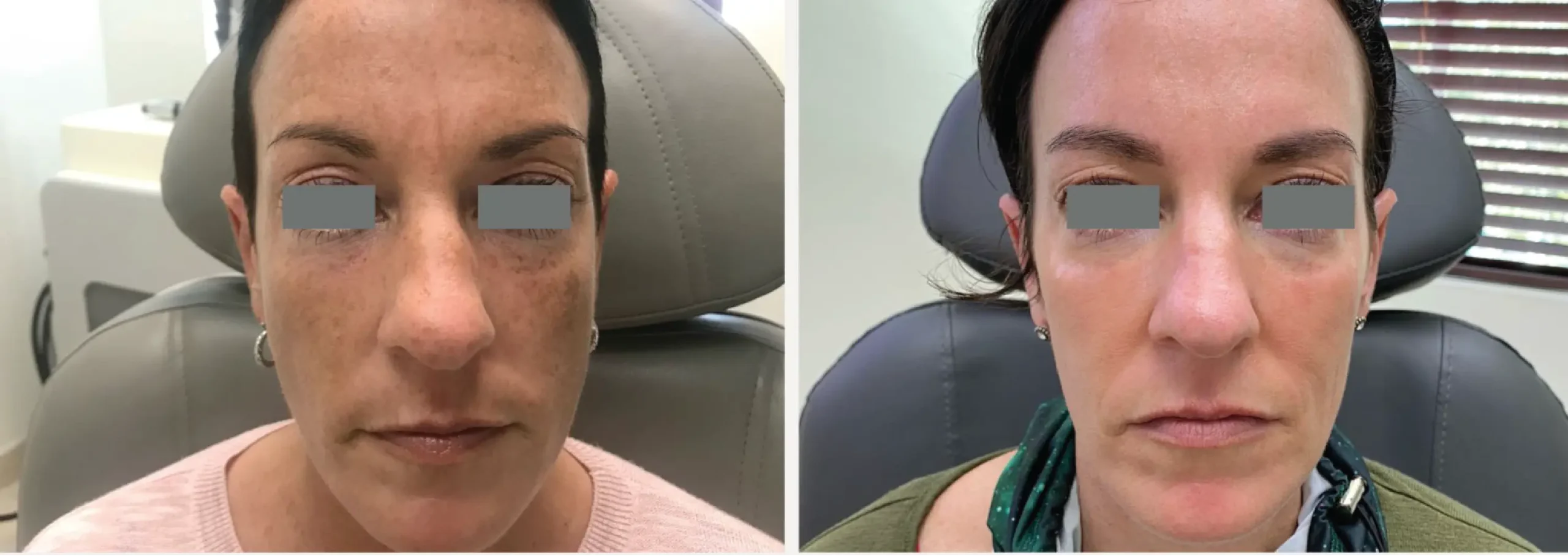 PicoWay® Pigment Removal scaled