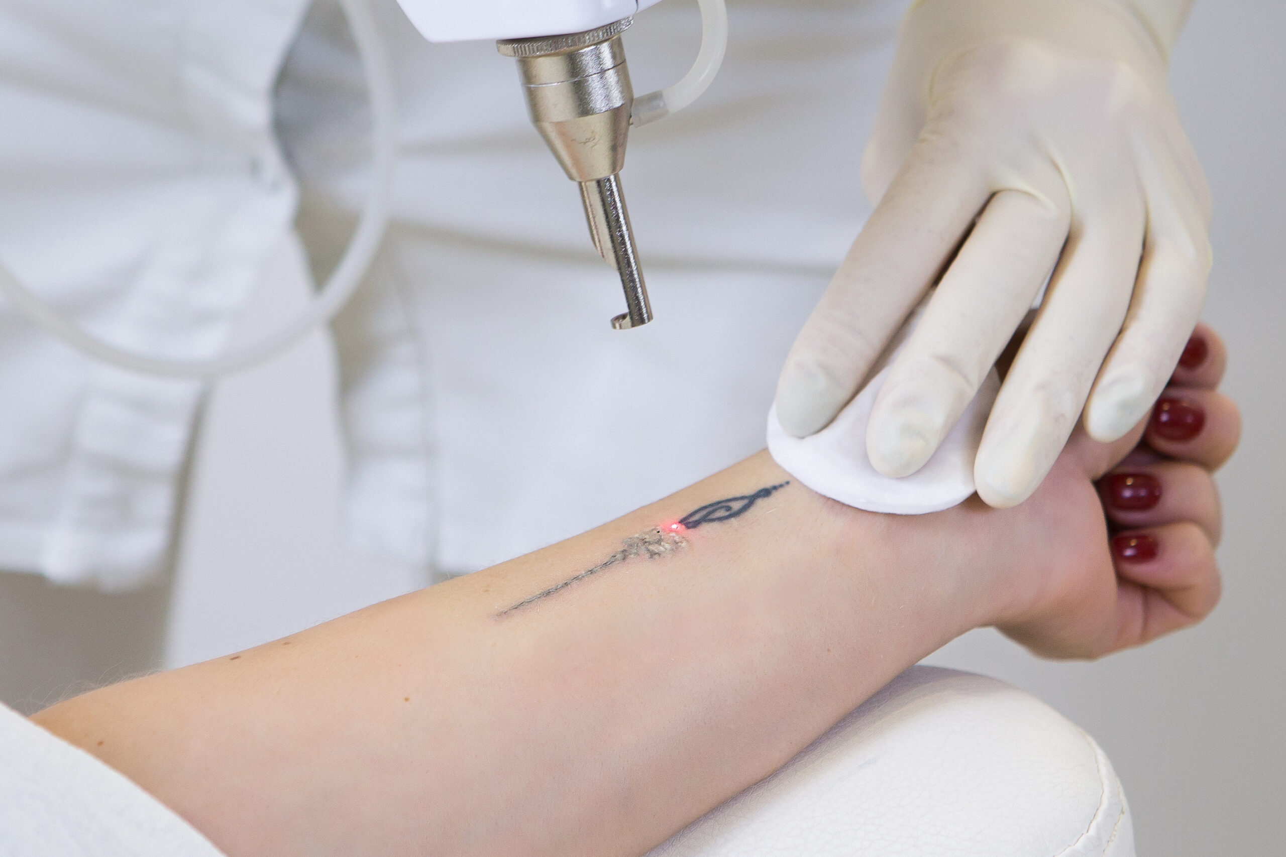 Benefits of Tattoo Removal in Brooklyn
