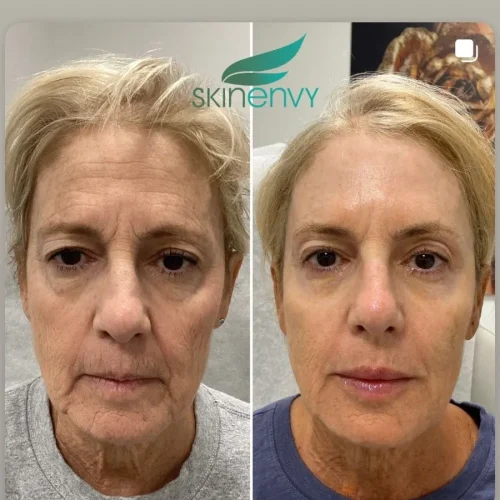 Volume Loss Treatment in Brooklyn, NY 2 Volume Loss Before and After