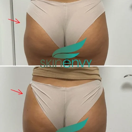 Volume Loss Treatment in Brooklyn, NY 1 Volume Loss Before and After