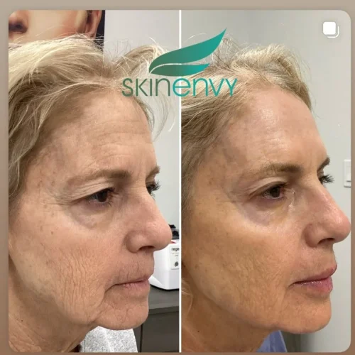 Volume Loss Treatment in Brooklyn, NY 3 Volume Loss Before and After