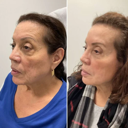 Volume Loss Treatment in Brooklyn, NY 4 Volume Loss Before and After