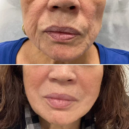 Volume Loss Treatment in Brooklyn, NY 5 Volume Loss Before and After