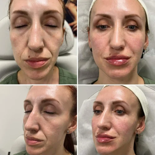 Volume Loss Treatment in Brooklyn, NY 6 Volume Loss Before and After