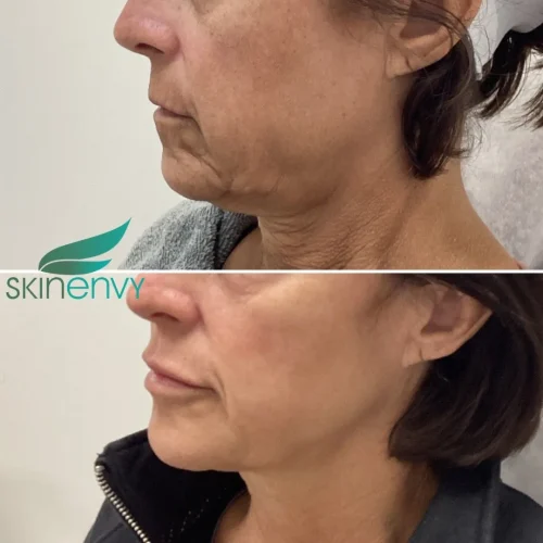 Volume Loss Treatment in Brooklyn, NY 7 Volume Loss Before and After