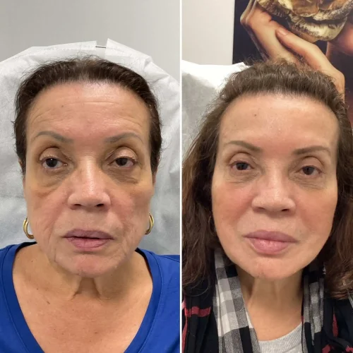 Volume Loss Treatment in Brooklyn, NY 8 Volume Loss Before and After