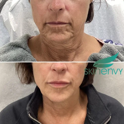 Volume Loss Treatment in Brooklyn, NY 9 Volume Loss Before and After