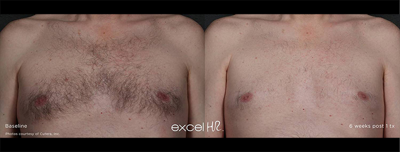 Excel HR hair removal Before & after Before & after Treatment result in Brooklyn NY by Skin Envy Cosmetic and Laser Center