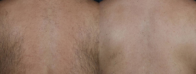 Excel HR hair removal Before & after Before & after Treatment result in Brooklyn NY by Skin Envy Cosmetic and Laser Center