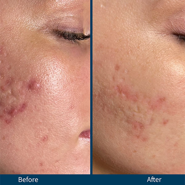Microneedling Before & after Treatment result in Brooklyn NY by Skin Envy Cosmetic and Laser Center